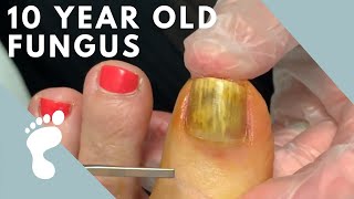 Fungus Takes Over Toenail  Toenail Removal [upl. by Kazue]