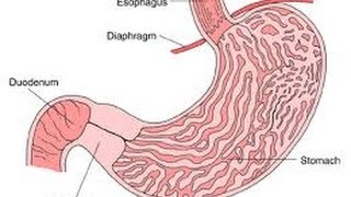 Pyloric Stenosis [upl. by Ecnav]