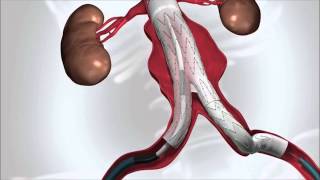 StentBehandlung  Aneurysma Aorta [upl. by Tierney]