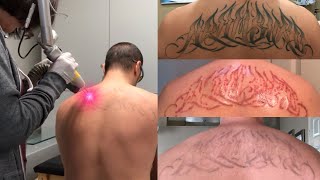 Laser Tattoo Removal  The Ugly Truth [upl. by Draner177]