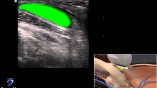 Nonsurgical treatment of Bakers Cyst with MediTape  Part 1 [upl. by Molloy878]