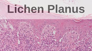 Lichen Planus  Pathology mini tutorial [upl. by Znieh]