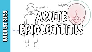 Acute Epiglottitis  signs and symptoms causes pathophysiology treatment [upl. by Gamaliel]