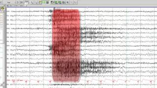 EEG in Juvenile Myoclonic Epilepsy [upl. by Vaden]