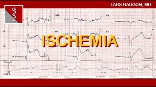 ECG Ischemia [upl. by Liane]