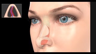 Deviated Septum Surgery Septoplasty [upl. by Schatz]