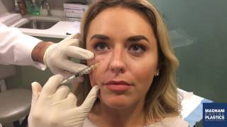 All About Facial Fillers  Which Filler Should I Choose [upl. by Sibelle670]