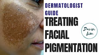 How to treat PIGMENTATION [upl. by Ecinahs]