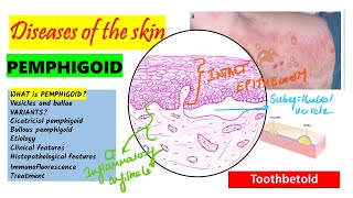 Pemphigoid Causes pathogenesis Types Histopathology Treatment  Pemphigus vs Pemphigoid [upl. by Donielle]