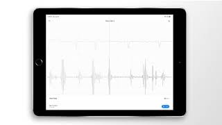 FibroScan® noninvasive liver assessment [upl. by Rowen]