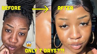 HOW I CLEARED MY SKIN in 1 WEEK and LIGHTENED my dark under eye circles [upl. by Pitts]