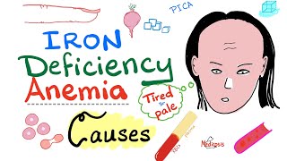 Iron Deficiency Anemia  Causes  Hematology Series [upl. by Ximenes]