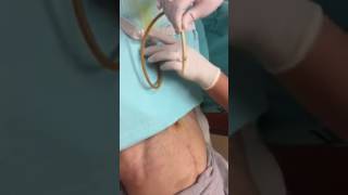 Suprapubic Catheter Change [upl. by Haney887]