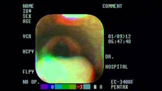 Epiglottic entrapment [upl. by Cindee]