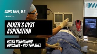 Bakers Cyst Aspiration  PRP [upl. by Tnairb979]