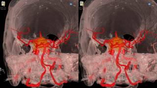 Cavernous Meningioma  3D Virtual Tour  UCLA Neurosurgery [upl. by Eyahs]