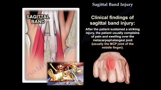 Sagittal Band Injury  Everything You Need To Know  Dr Nabil Ebraheim [upl. by Nahtnamas]