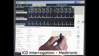 ICD interrogation  Medtronic [upl. by Neerroc]