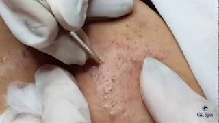 Acnes Treatment Service Popping Blackhead Acnes Ver 2 [upl. by Werdnaed]