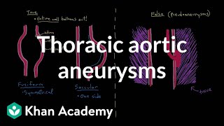 Thoracic aortic aneurysms  Circulatory System and Disease  NCLEXRN  Khan Academy [upl. by Shayne922]