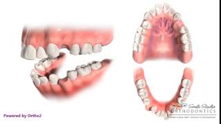 4 First Premolar Extraction for Retraction  Orthodontic Treatment [upl. by Ntsuj]