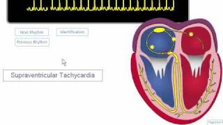 ECG Rhythm Review SVT Atrial Fibrillation Atrial Flutter [upl. by Mccollum119]