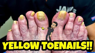 CUTTING INSANELY YELLOW TOENAILS WITH FUNGUS [upl. by Iohk791]