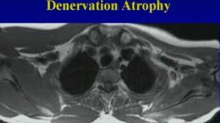 Imaging of the Brachial Plexus [upl. by Shriner]