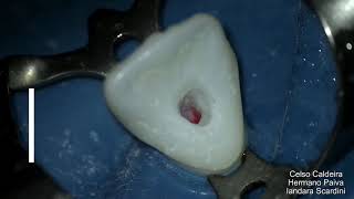 Endodontia Cirurgia de acesso Incisivo Central Superior [upl. by Haynor]