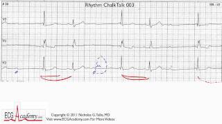 ECG Interpretation Tutorial  ChalkTalk 03  Advanced Level [upl. by Anayrb198]