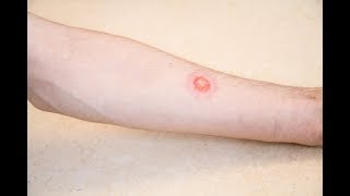 How to Manage Ringworm on scalpTinea Capitis Peds [upl. by Llennoj14]