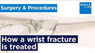 How a wrist fracture is treated  Bupa Health [upl. by Epuladaug]