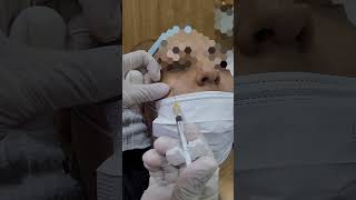 Periorbital Undereye Veins Treatment  Geria Dermatology [upl. by Akilegna]