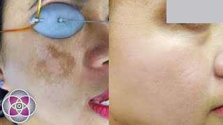 Laser Melasma amp Hyperpigmentation Treatment [upl. by Oiramel]