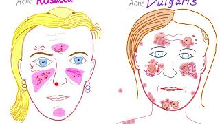 Acne Vulgaris Vs Acne Rosacea [upl. by Sumer]