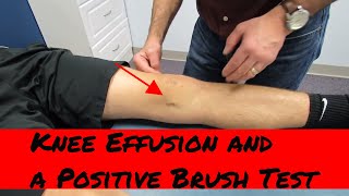 Knee effusion positive brush test and intraarticular knee injury eval [upl. by Artinak]