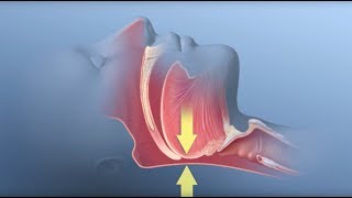 Sleep apnea causes symptoms diagnosis treatment pathology [upl. by Vada]