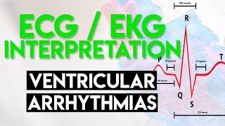 Ventricular Arrhythmias  ECG EKG Interpretation Part 5 [upl. by Luciana]