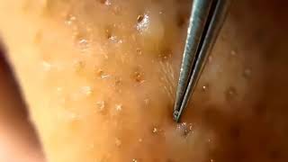 BLACKHEADS AND WHITEHEADS REMOVAL BY TWEEZERS [upl. by Marrissa]