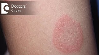 How to manage Chronic Ringworm infection  Dr Rajdeep Mysore [upl. by Eitsyrc]